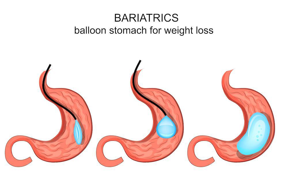 Lunch halfrond Vergelijking 4 Benefits of Losing Weight With a Gastric Balloon – Trinity Bariatric  Institute